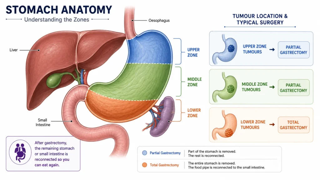 Gastric (Stomach) Cancer Treatment in Delhi NCR